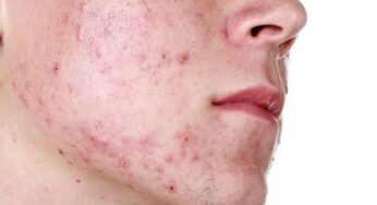 بينها الخبز.. مواد غذائية تسبب ظهور حب الشباب على الوجه
